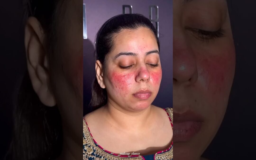 Acne & Redness Cover Makeup Tutorial ✨#makeup #makeuptutorial #makeupartist